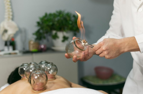 “Therapist performing Hijama wet cupping on upper back”