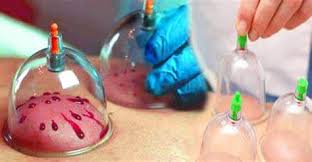 Hijama